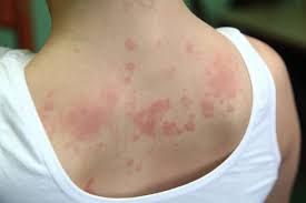 Urticaria